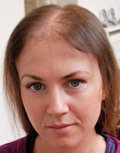 files/Intralace_Gallery_-_before_and_after_Intralace_System_hair_loss_treatment.jpg